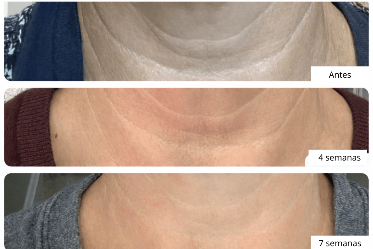 NeckLuxe - Reafirma tu cuello en 4 semanas