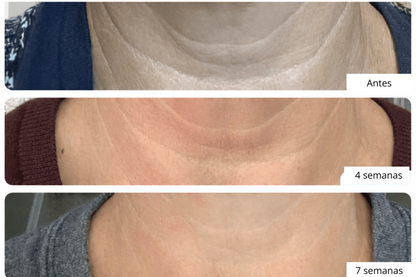 NeckLuxe - Reafirma tu cuello en 4 semanas